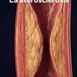 La grasa en tus arterias : La aterosclerosis.