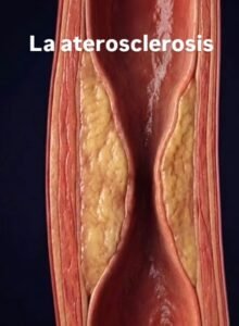 La grasa en tus arterias : La aterosclerosis.