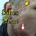 la leishmaniasis … miren esta lesion atipica