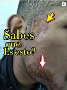 la leishmaniasis … miren esta lesion atipica